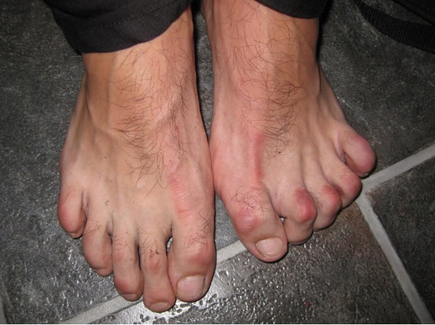 Hamertenen Orthopedie Lier Orthopedie Lier