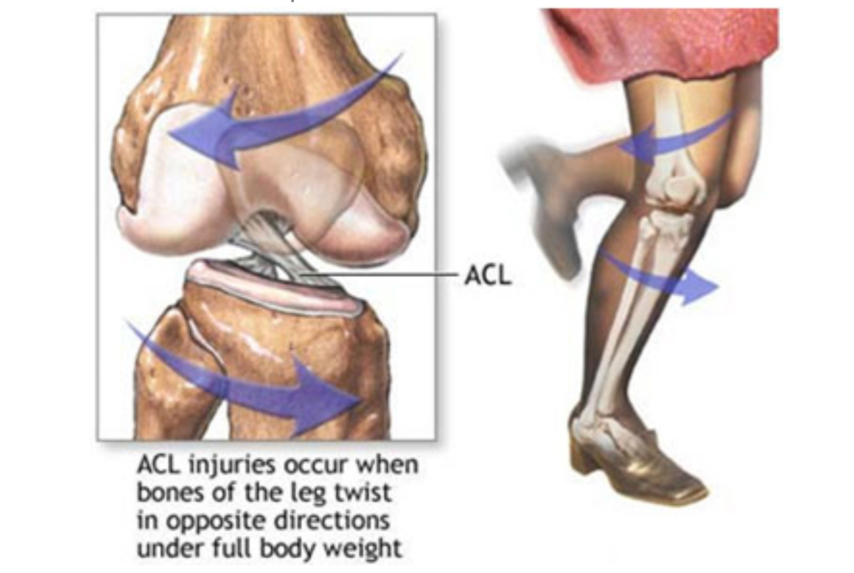 Kruisbandletsel Orthopedie Lier Orthopedie Lier