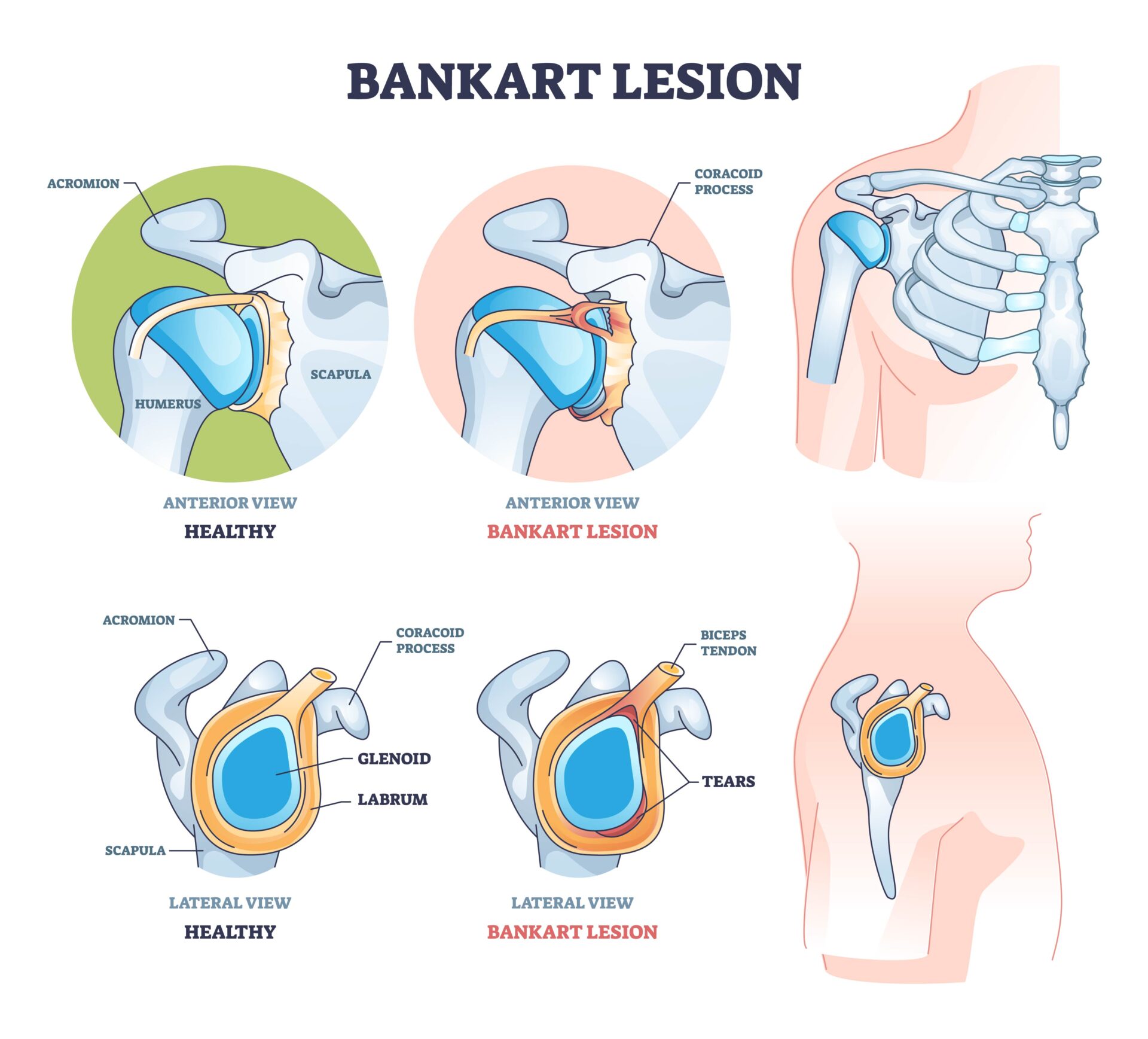 Schouderluxatie en schouderinstabiliteit - Orthopedie Lier : Orthopedie ...